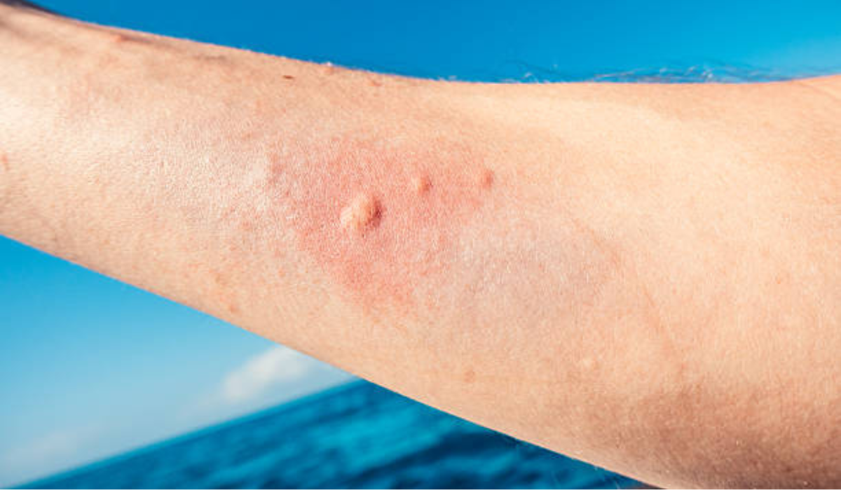 Picadura de medusa, ¿qué pasos hay que seguir?